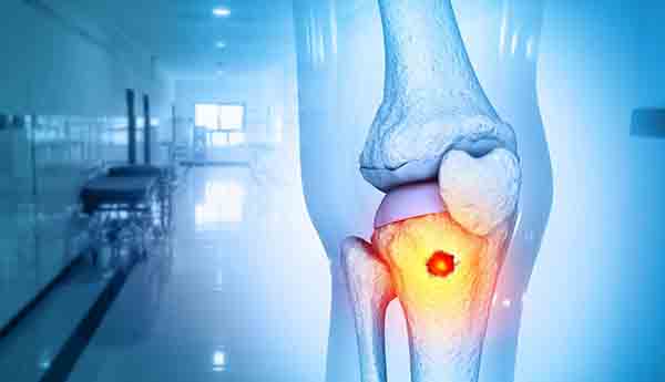 Health News : हाडांच्या कर्करोगाची लक्षणे : थकवा-कमकुवतपणा... कर्करोग हाडांना वाळवीसारखे खाईल, या ५ लक्षणांकडे दुर्लक्ष करू नका
