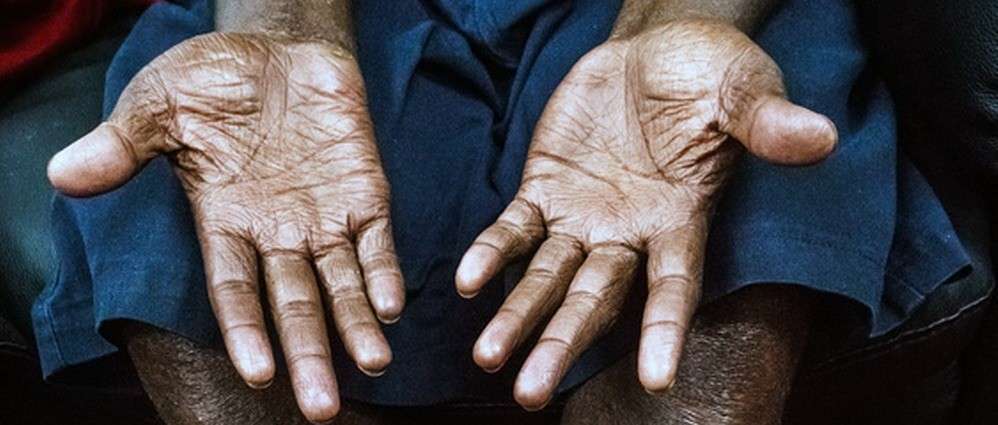 छत्रपती संभाजीनगर जिल्ह्यात १७ नोव्हेंबरपासून कुष्ठरुग्ण शोध अभियान