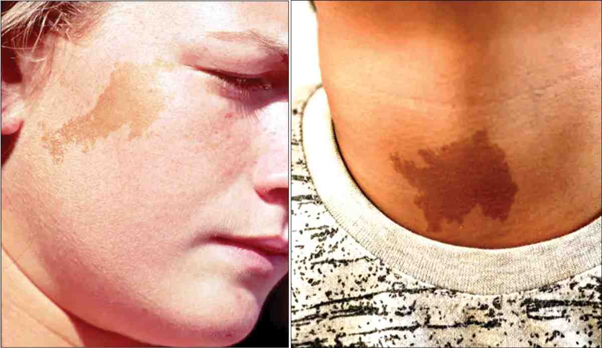 जन्मचिन्हांचा भूतकाळाशी संबंध? तुमच्या शरीरावरील विशेष चिन्हावरून काय कळते जाणून घ्या...